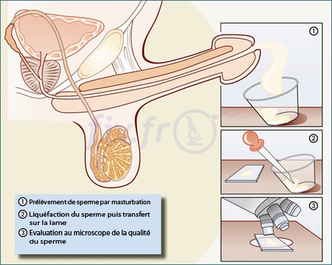 1-spermogramme