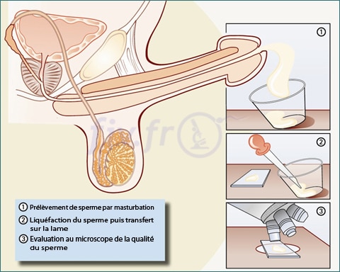 1-spermogramme