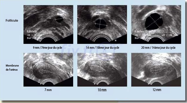 4-follicules-endometre