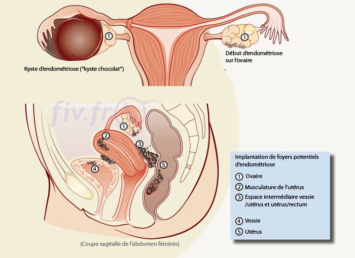 Endometriose • Fiv.fr