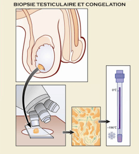 biopsie-testiculaire