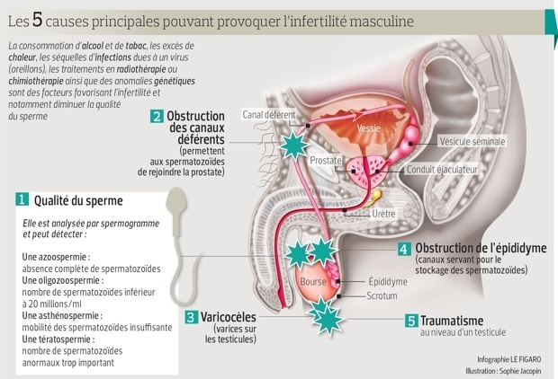 causes infertilite masculine