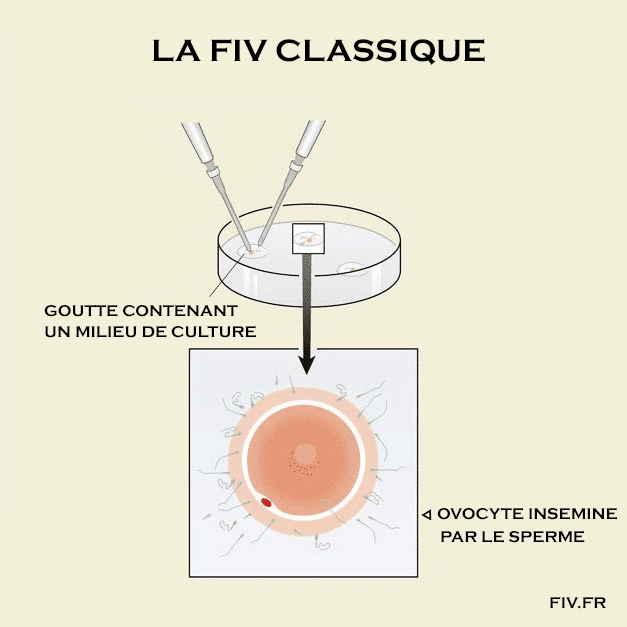 Schéma d'une fécondation in vitro classique