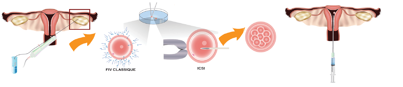 Qu’est ce qu’une FIV ?
