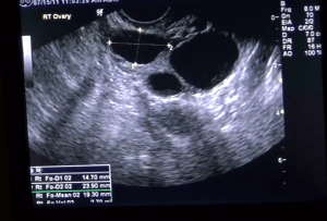 Mesure follicule