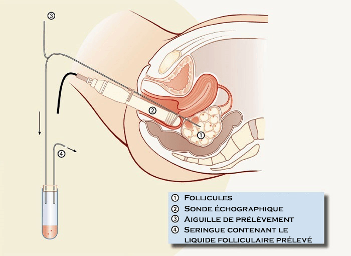 ponction-ovocytes