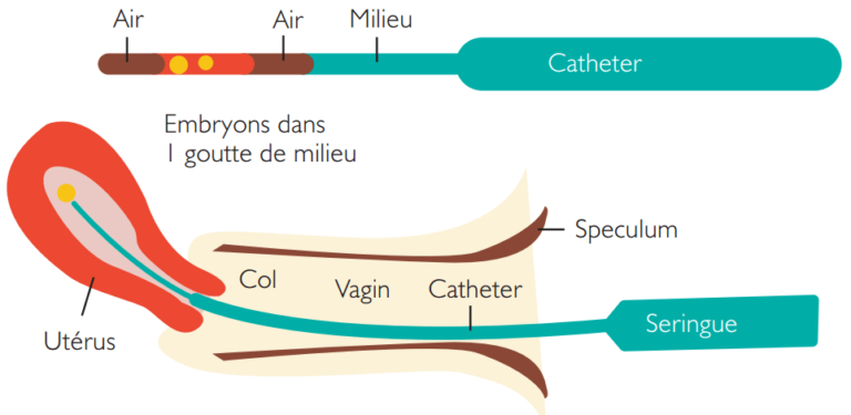 Le transfert d’embryons